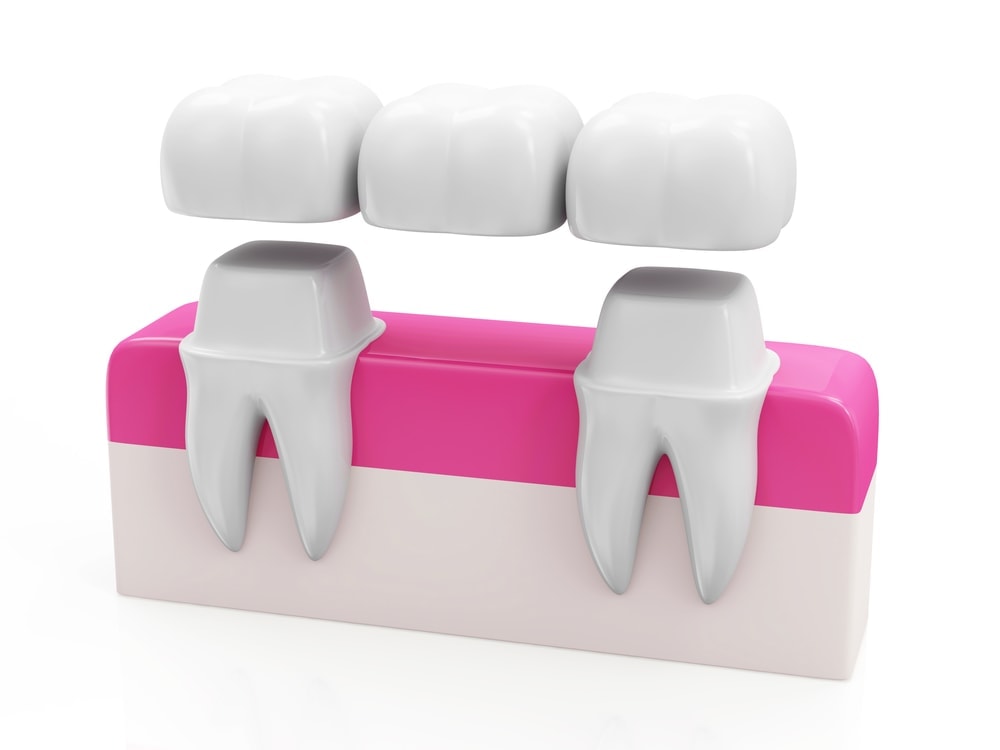 Diagram of a Dental Tooth Bridge