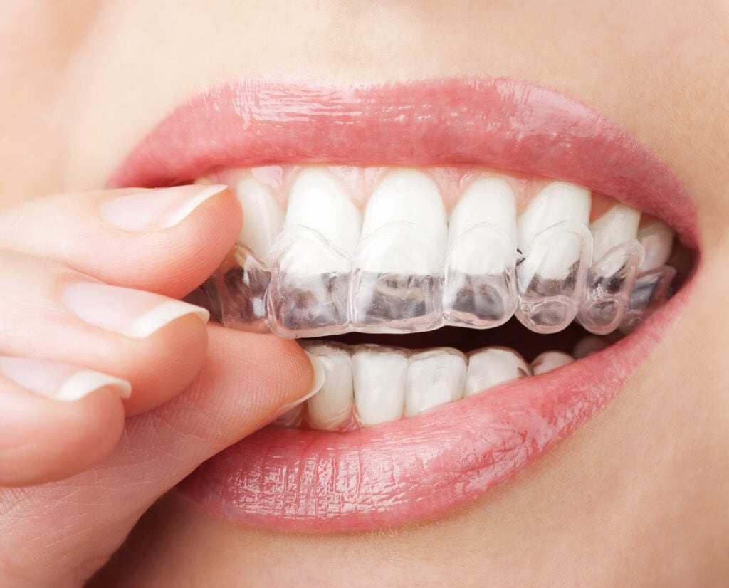 teeth with whitening tray being placed